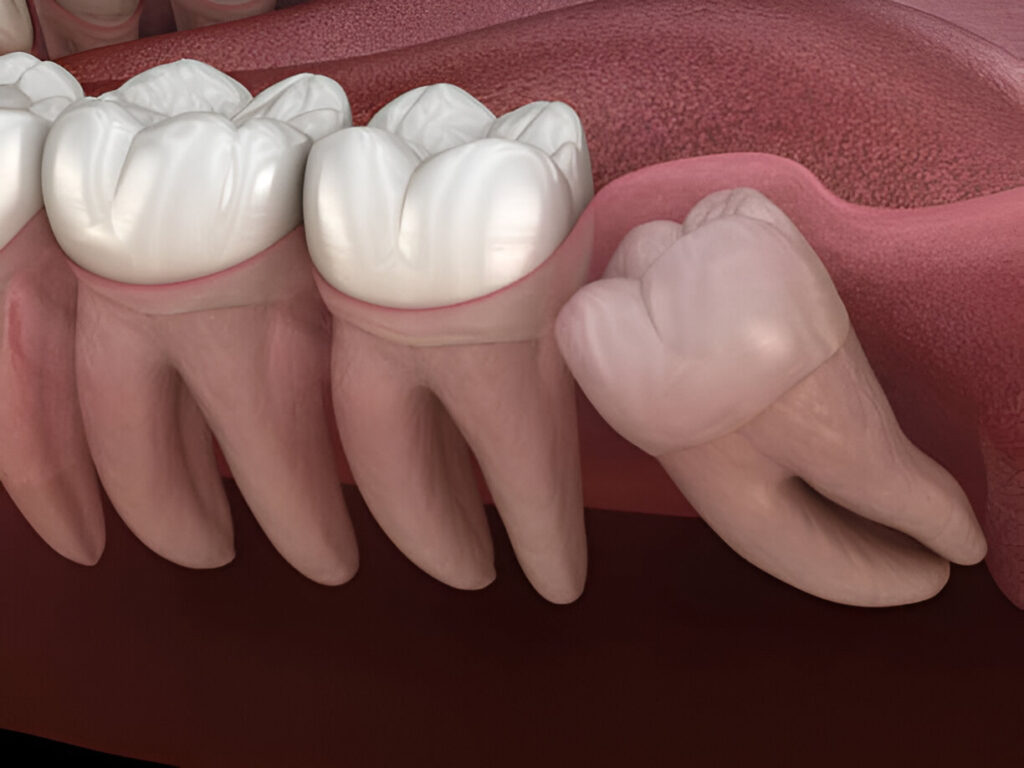 Wisdom tooth extraction in Mohali
