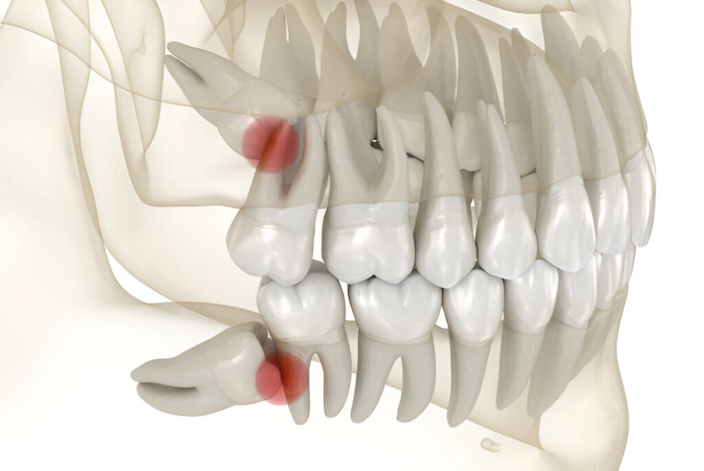 Wisdom tooth extraction in Mohali