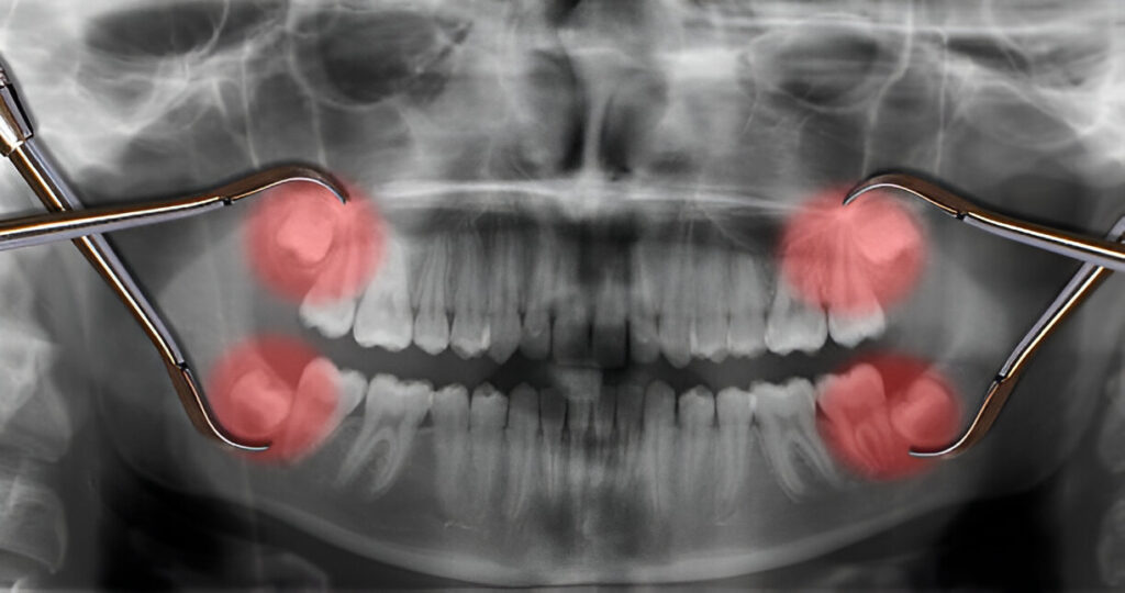 Wisdom tooth extraction in Mohali