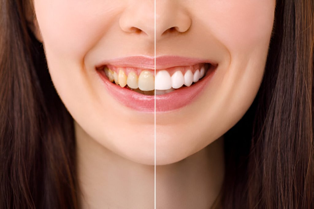 Teeth cleaning and whitening in Mohali