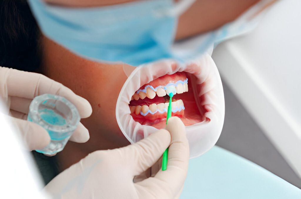 Teeth cleaning and whitening in Mohali