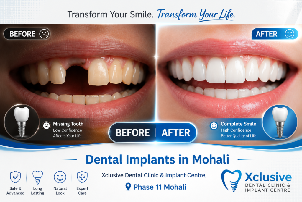 xclusive-dental-implant
